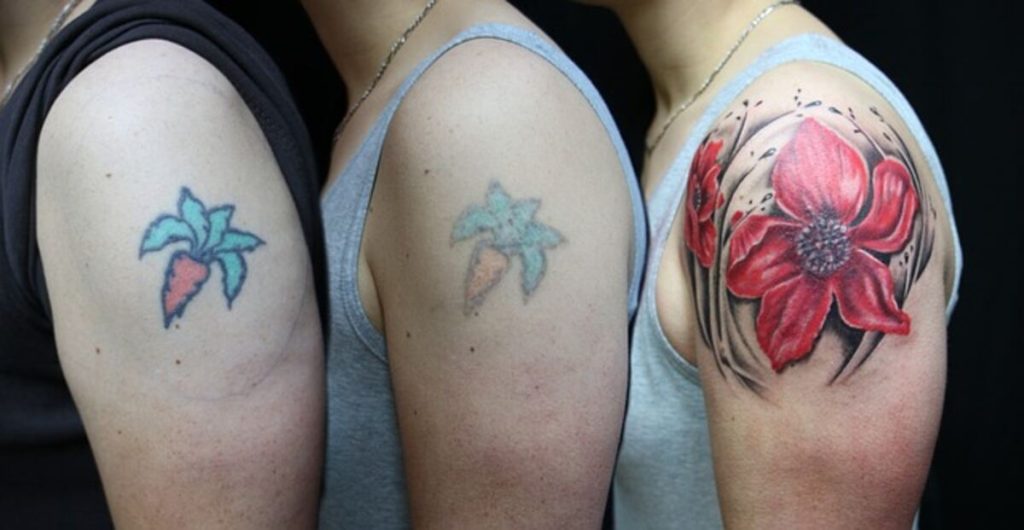 Tattoo Removal